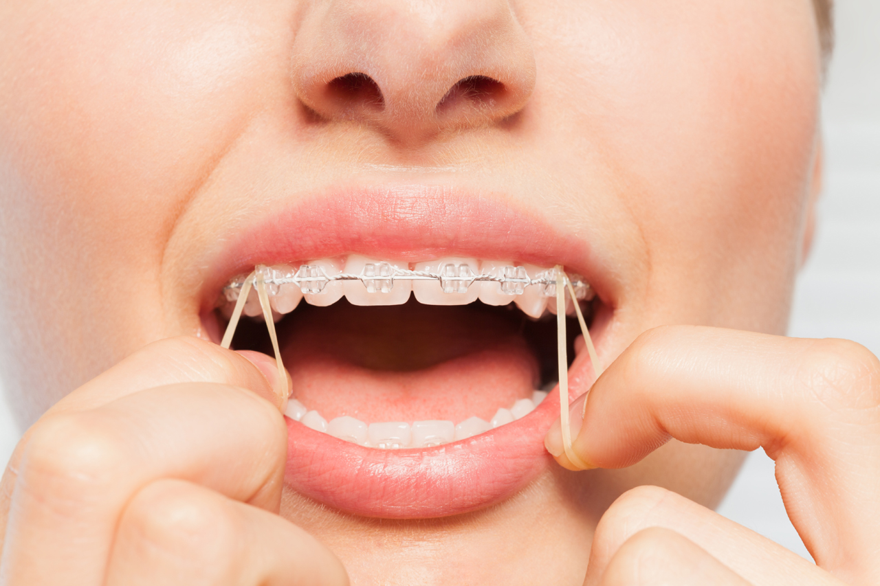 Teeth Gap Bands and Your Safety