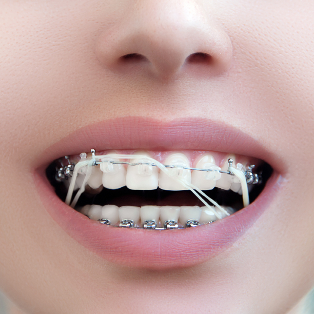 Teeth Gap Bands