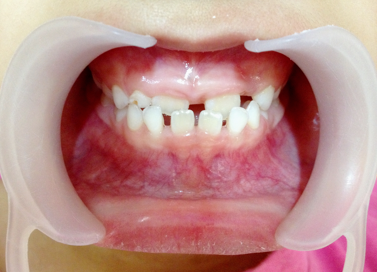 The Diastema Treatment