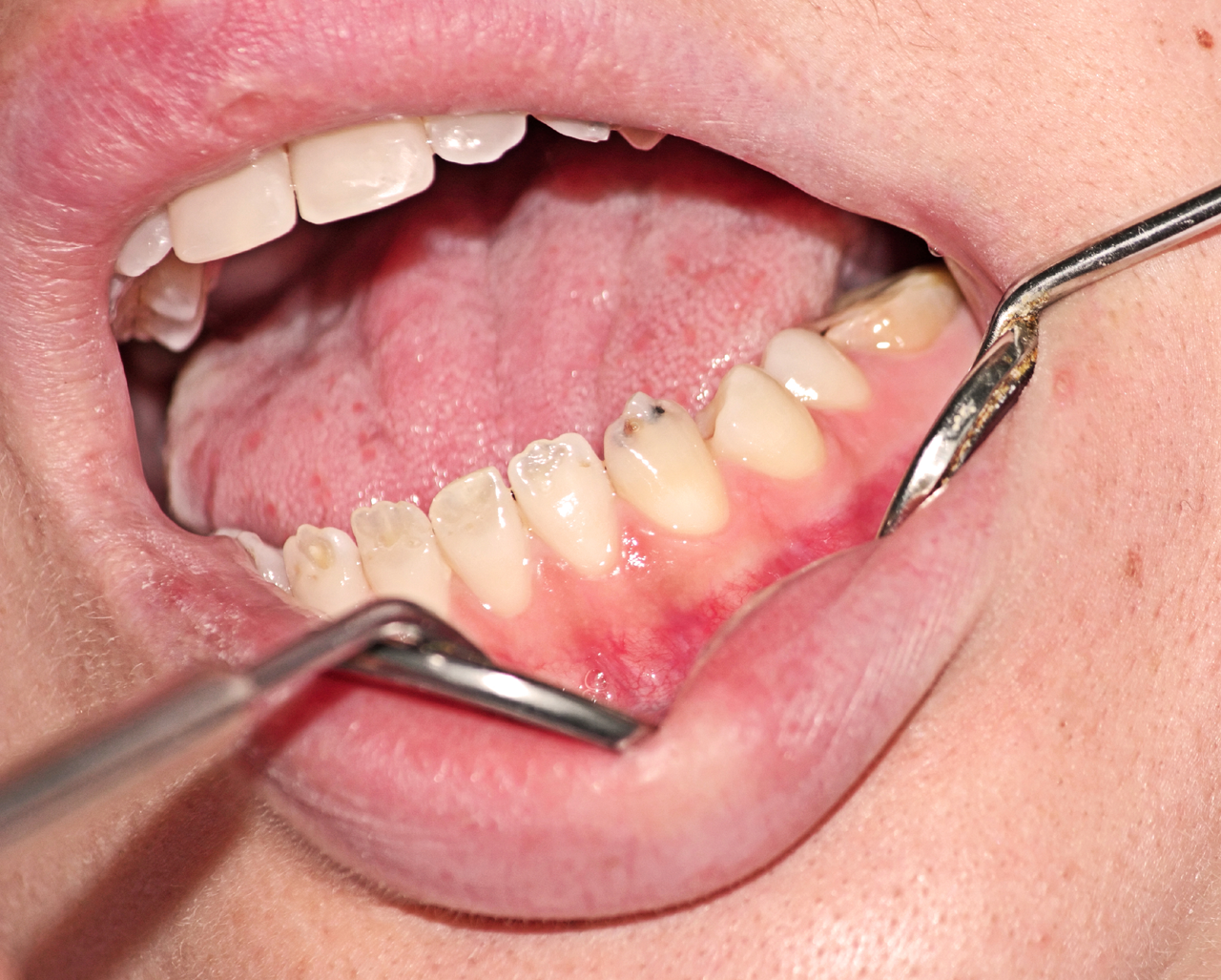 The Enamel Hypoplasia Treatment