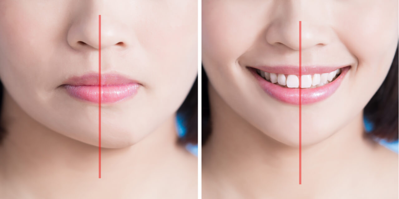 What To Expect During Jaw Plastic Surgery