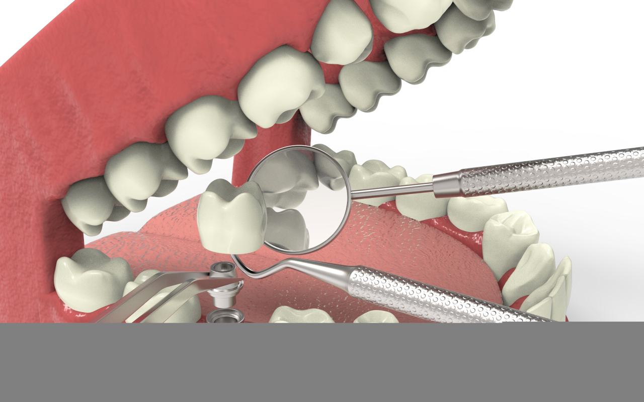 Dental Implants Procedure Steps