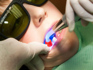 laser dental fillings