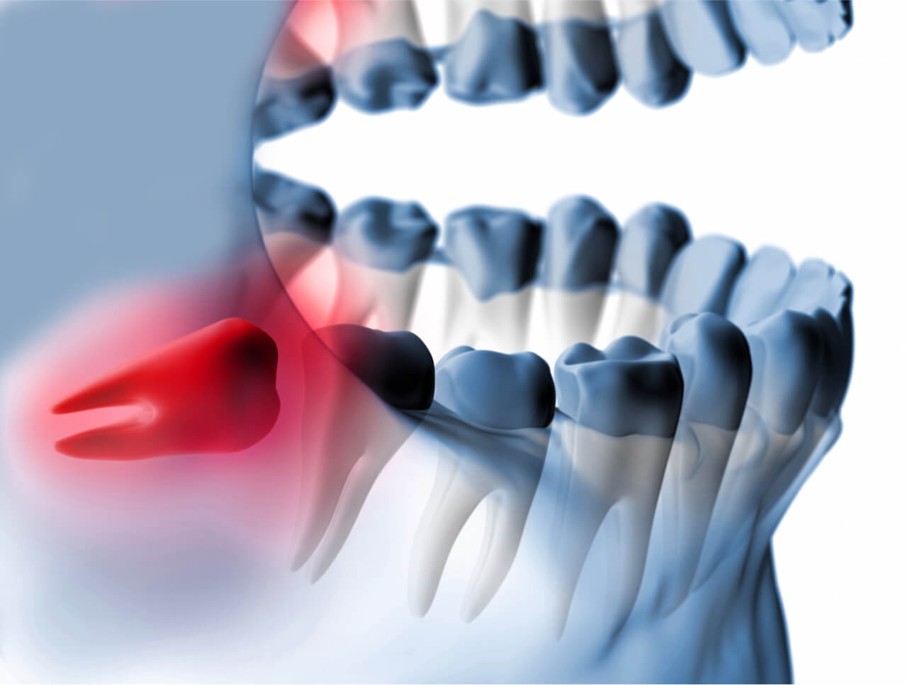 Removal of Impacted Teeth