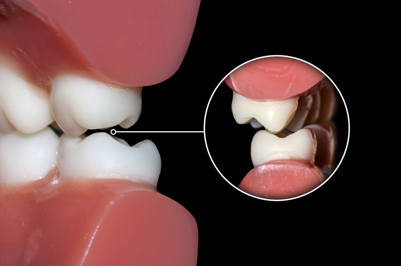 Dental Occlusion