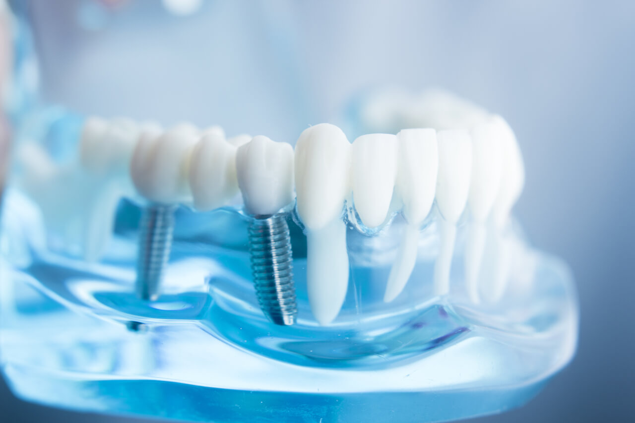 Are teeth implants safe?