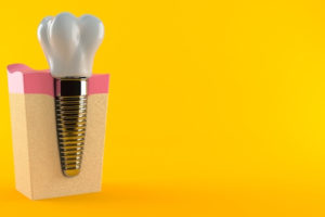 tooth implant or bridge