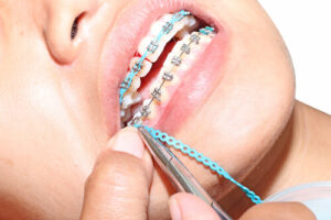 negative effects of braces difficulties