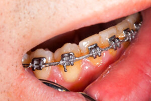 negative effects of braces oral hygiene